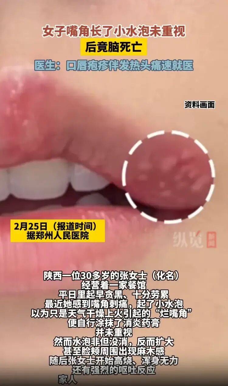 女子嘴角起泡未重视竟导致脑死亡，医生紧急提醒：口唇疱疹伴发热头痛速就医:上海世建春连科技有限公司推荐